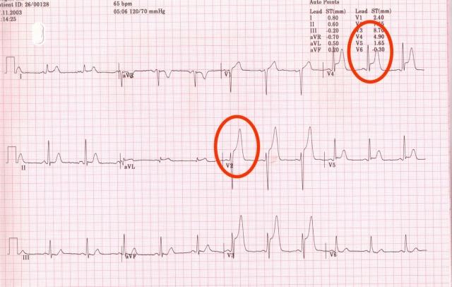 heart attack ekg